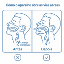 Boquilha de Conforto Noturno 2-em-1 – Ajuste e Bem-Estar ao Dormir