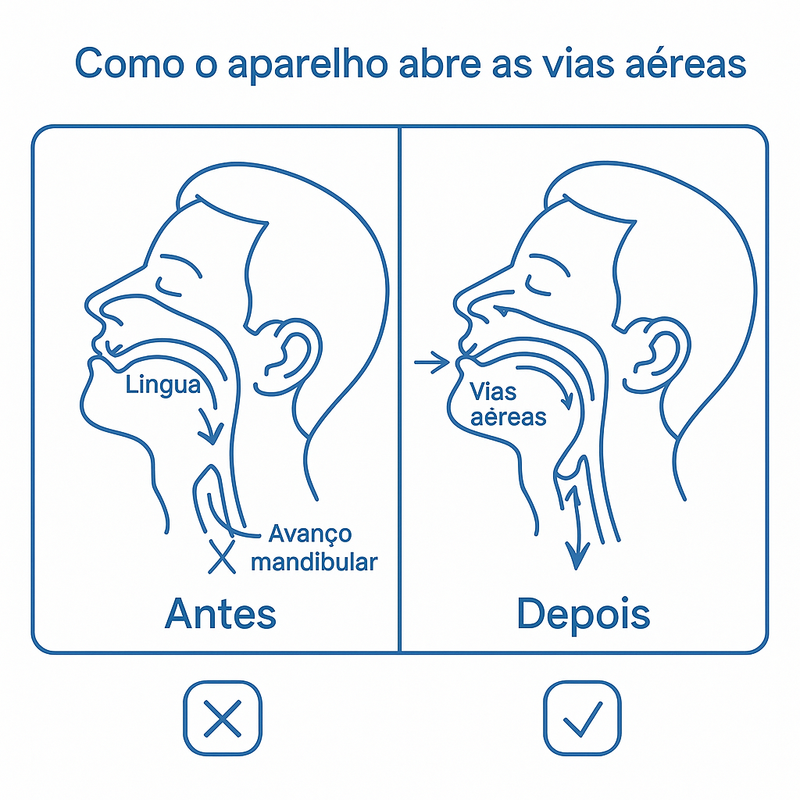 Boquilha de Conforto Noturno 2-em-1 – Ajuste e Bem-Estar ao Dormir